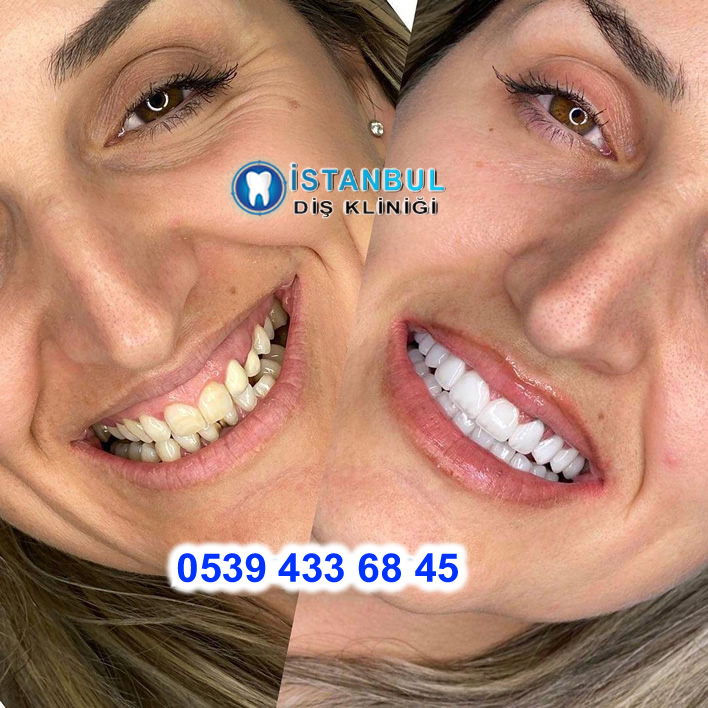 diş yaptırma fiyatları